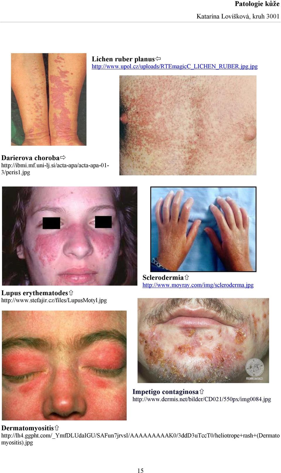 jpg Sclerodermia http://www.moyray.com/img/scleroderma.jpg Impetigo contaginosa http://www.dermis.