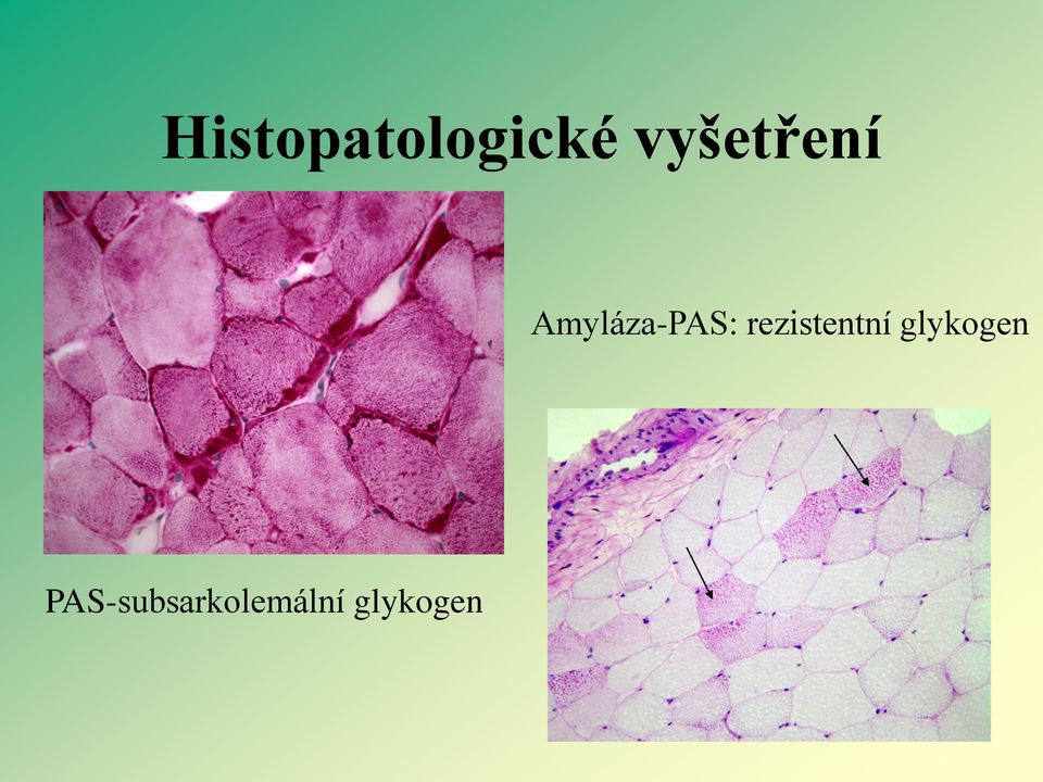 rezistentní glykogen