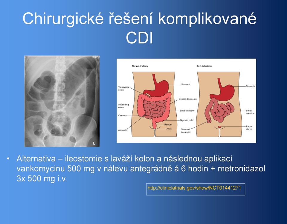 vankomycinu 500 mg v nálevu antegrádně á 6 hodin +