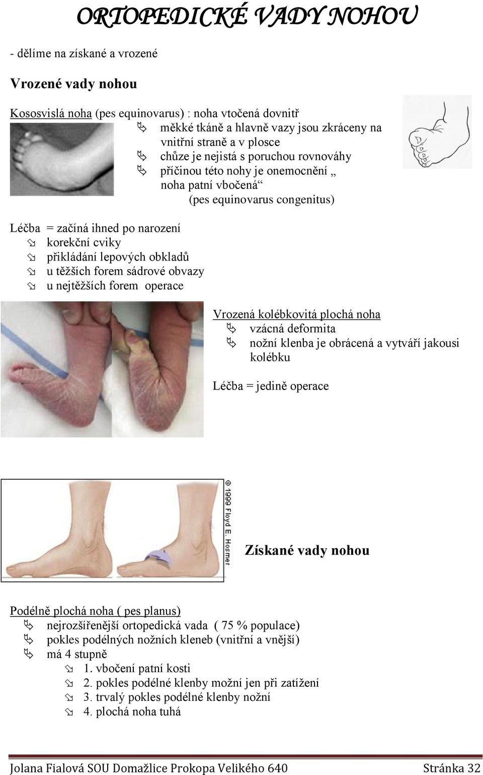 těžších forem sádrové obvazy u nejtěžších forem operace Vrozená kolébkovitá plochá noha vzácná deformita nožní klenba je obrácená a vytváří jakousi kolébku Léčba = jedině operace Získané vady nohou