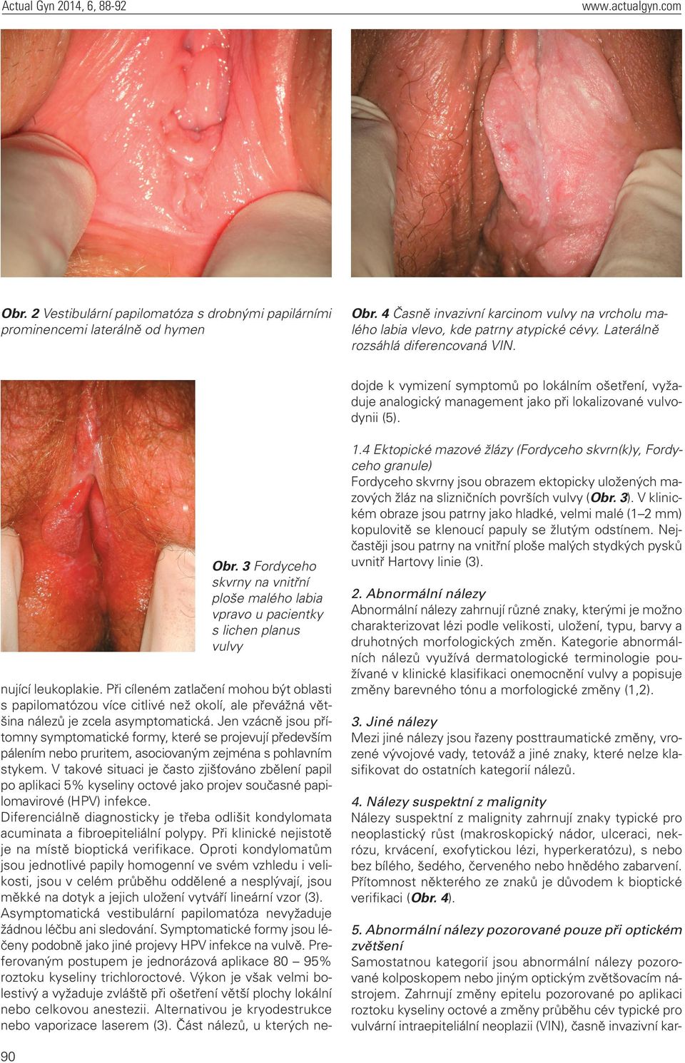 dojde k vymizení symptomů po lokálním ošetření, vyžaduje analogický management jako při lokalizované vulvodynii (5). Obr.