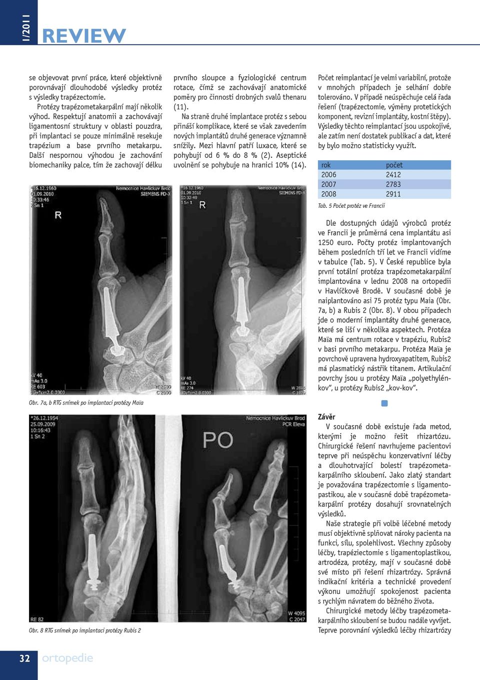 Další nespornou výhodou je zachování biomechaniky palce, tím že zachovají délku Obr. 7a, b RTG snímek po implantaci protézy Maïa Obr.