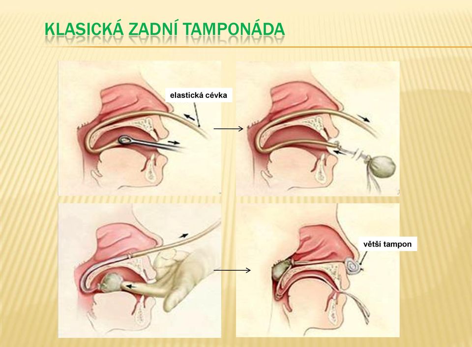 TAMPONÁDA