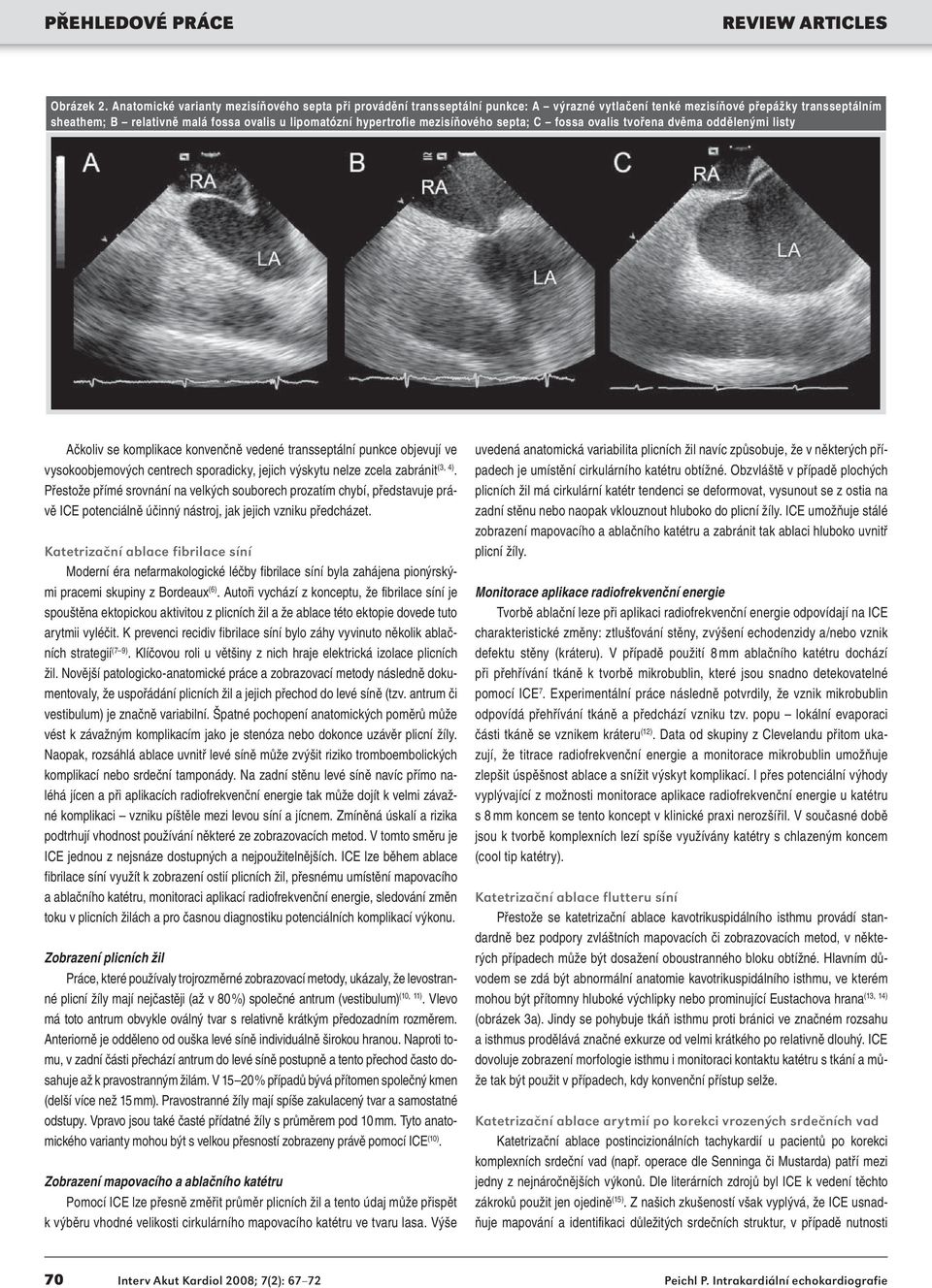 hypertrofie mezisíňového septa; C fossa ovalis tvořena dvěma oddělenými listy Ačkoliv se komplikace konvenčně vedené transseptální punkce objevují ve vysokoobjemových centrech sporadicky, jejich