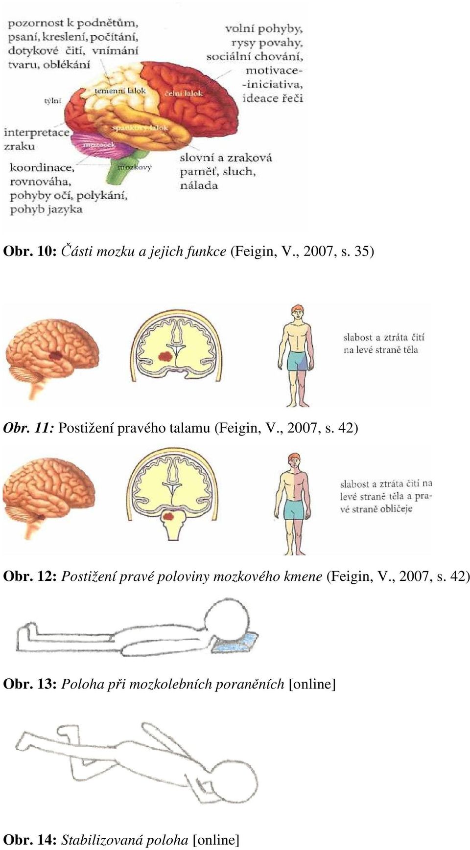 12: Postižení pravé poloviny mozkového kmene (Feigin, V., 2007, s.