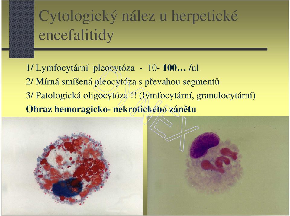 pleocytóza s převahou segmentů 3/ Patologická oligocytóza!