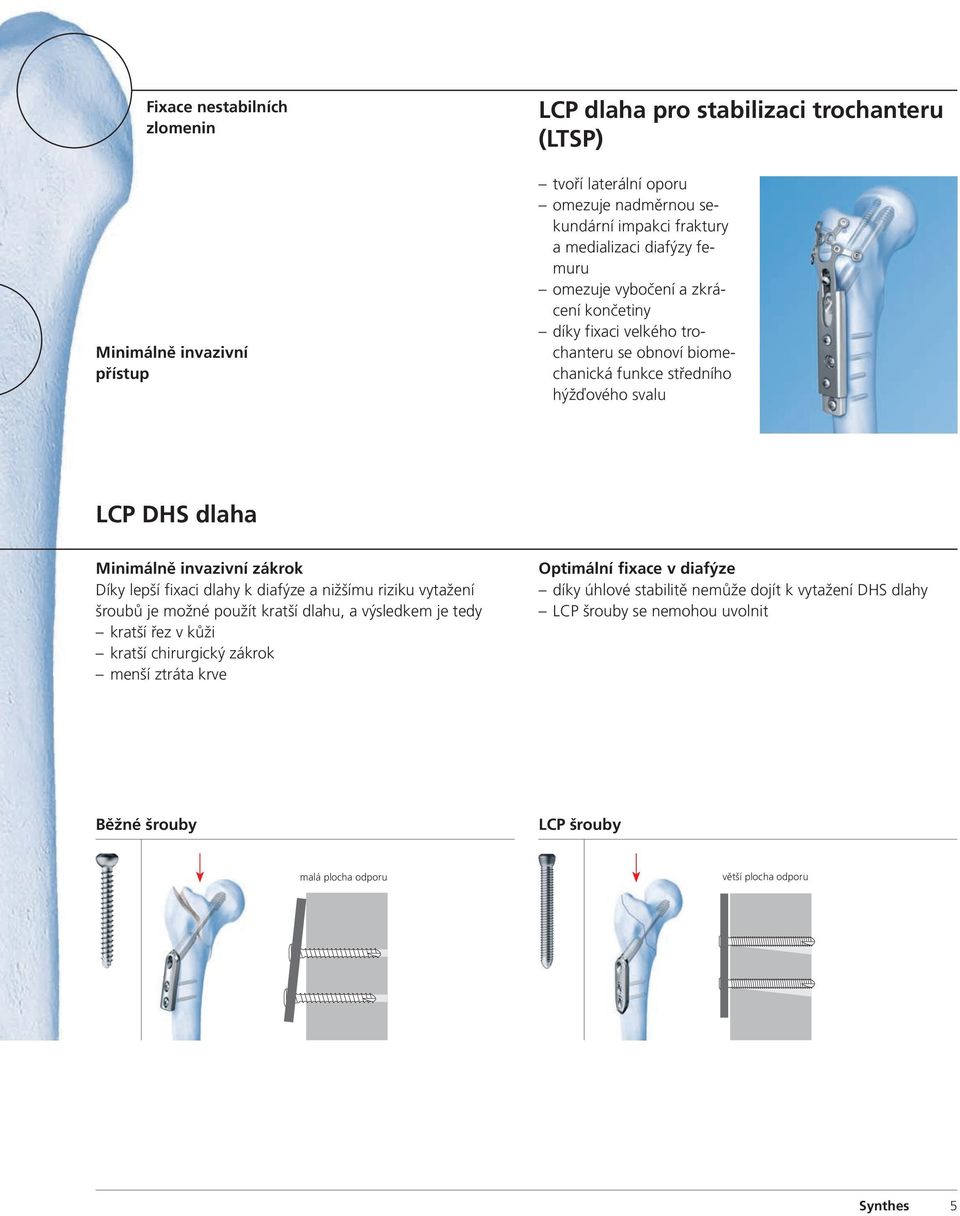 invazivní zákrok Díky lepší fixaci dlahy k diafýze a nižšímu riziku vytažení šroubů je možné použít kratší dlahu, a výsledkem je tedy kratší řez v kůži kratší chirurgický zákrok