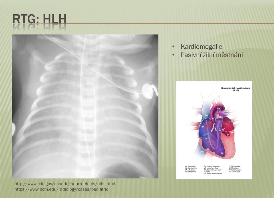 gov/ncbddd/heartdefects/hlhs.