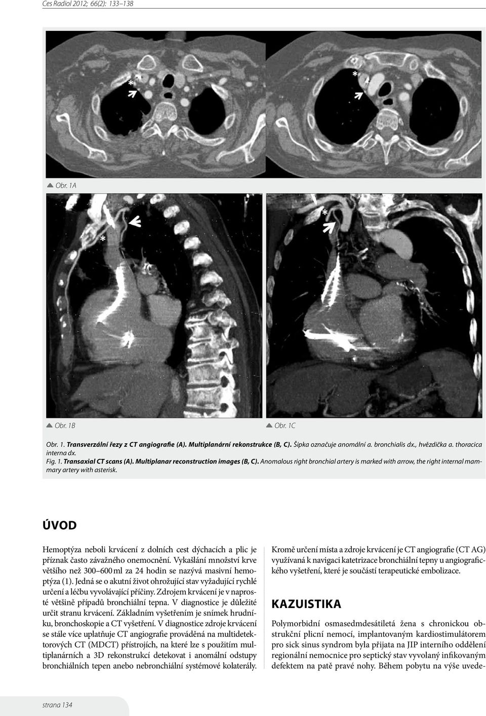 Úvod Hemoptýza neboli krvácení z dolních cest dýchacích a plic je příznak často závažného onemocnění. Vykašlání množství krve většího než 300 600 ml za 24 hodin se nazývá masivní hemoptýza (1).