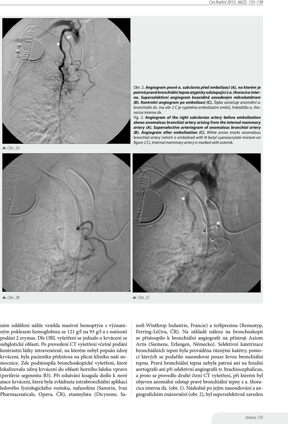 (na obr 2 C je vyplněna embolizační směsí), hvězdička a. thoracica interna dx. Fig. 2. Angiogram of the right subclavian artery before embolization shows anomalous bronchial artery arising from the internal mammary artery (A).