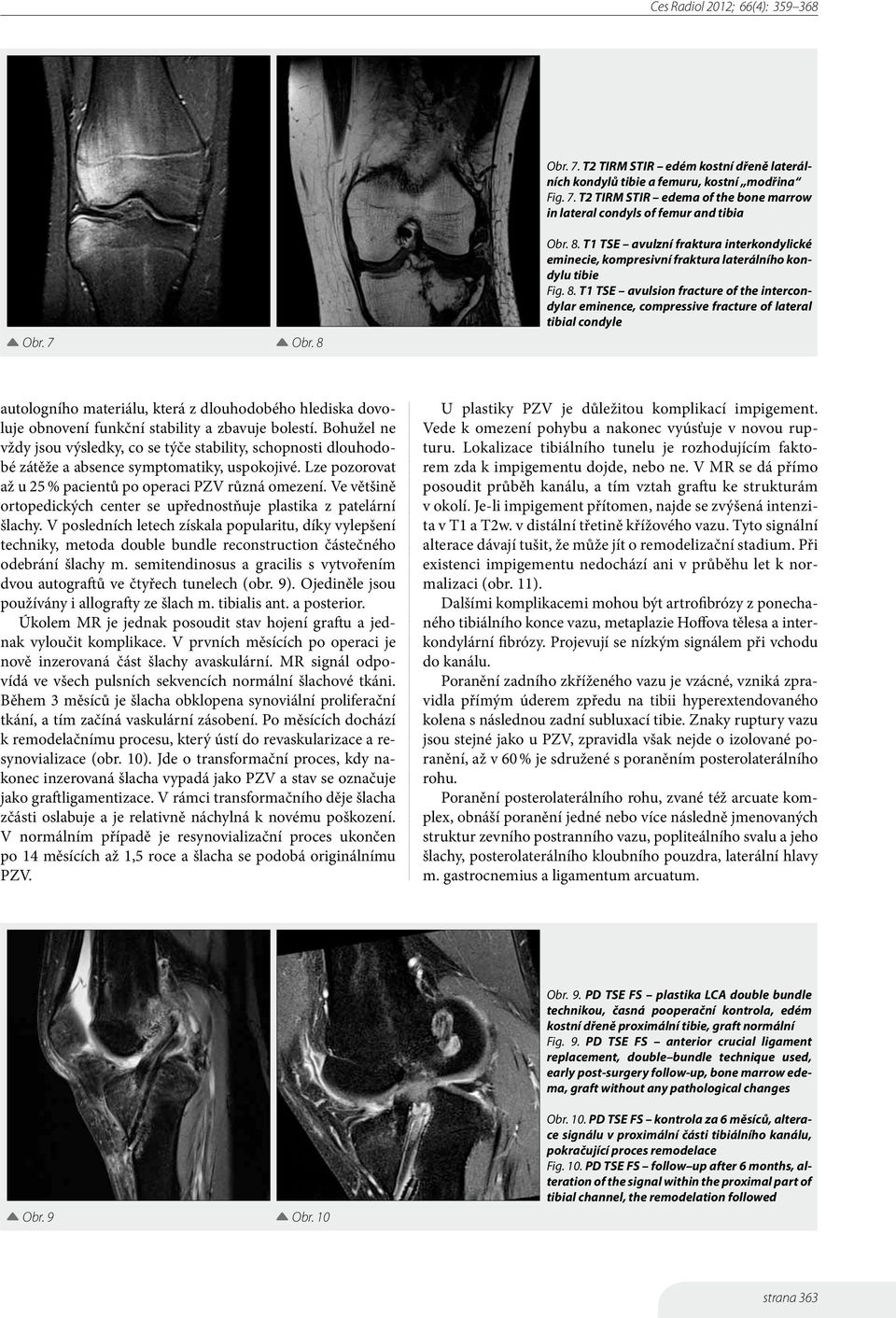 T1 TSE avulzní fraktura interkondylické eminecie, kompresivní fraktura laterálního kondylu tibie Fig. 8.