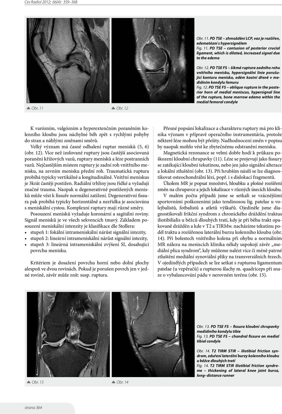 PD TSE FS šikmá ruptura zadního rohu vnitřního menisku, hypersignální linie porušující konturu menisku, edém kostní dřeně v mediálním kondylu femuru Fig. 12.