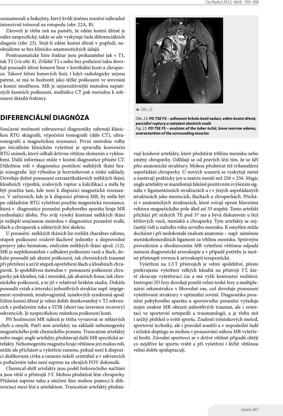 Stojí-li edém kostní dřeně v popředí, neobejdeme se bez klinicko-anamnestických údajů. Posttraumatické linie fraktur jsou prokazatelné jak v T1, tak T2 (viz obr. 8).