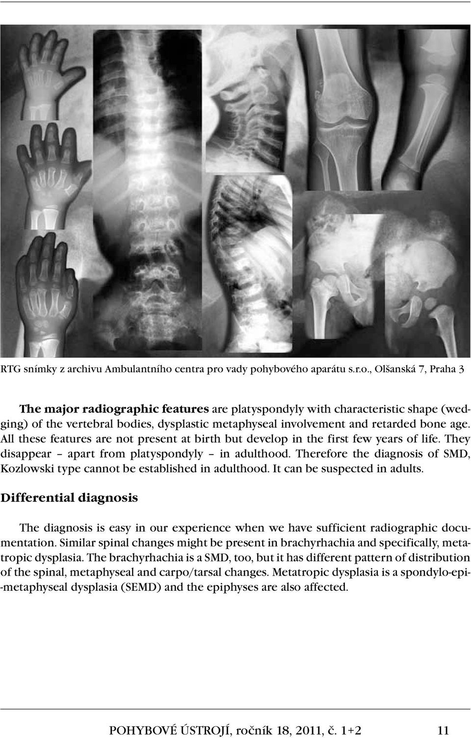 vady pohybového aparátu s.r.o., Olšanská 7, Praha 3 The major radiographic features are platyspondyly with characteristic shape (wedging) of the vertebral bodies, dysplastic metaphyseal involvement and retarded bone age.