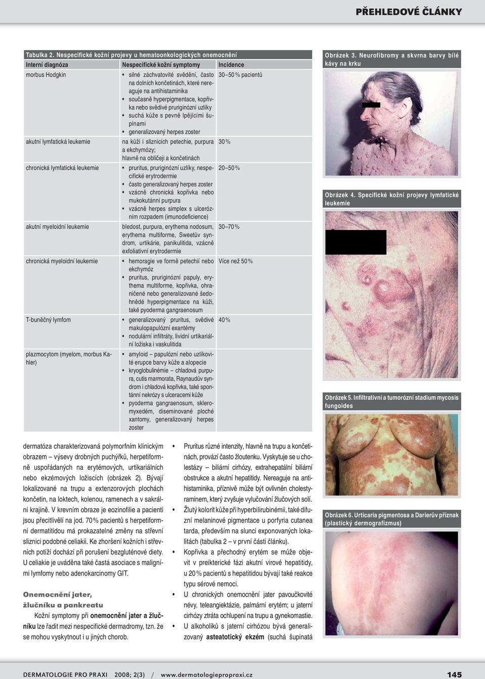 končetinách, které nereaguje na antihistaminika současně hyperpigmentace, kopřivka nebo svědivé pruriginózní uzlíky suchá kůže s pevně lpějícími šupinami generalizovaný herpes zoster akutní