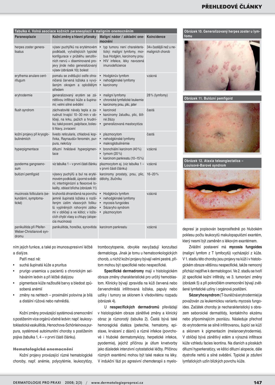 centrifugum erytrodermie flush syndrom kožní projevy při kryoglobulinémiích hyperpigmentace pyoderma gangraenosum bulózní pemfigoid mucinosis follicularis (sekundární, symptomatické) panikulitida při