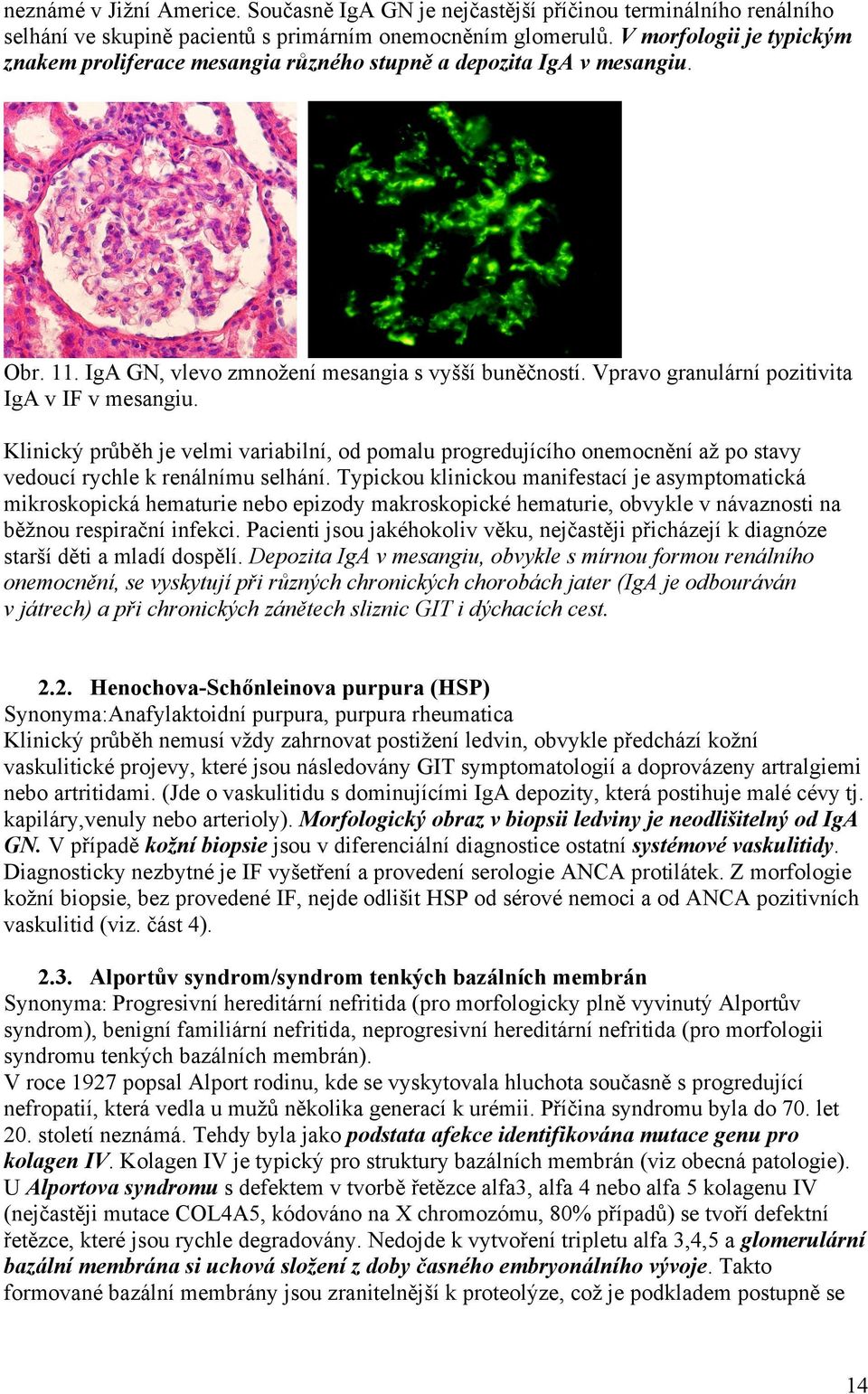 Vpravo granulární pozitivita IgA v IF v mesangiu. Klinický průběh je velmi variabilní, od pomalu progredujícího onemocnění až po stavy vedoucí rychle k renálnímu selhání.