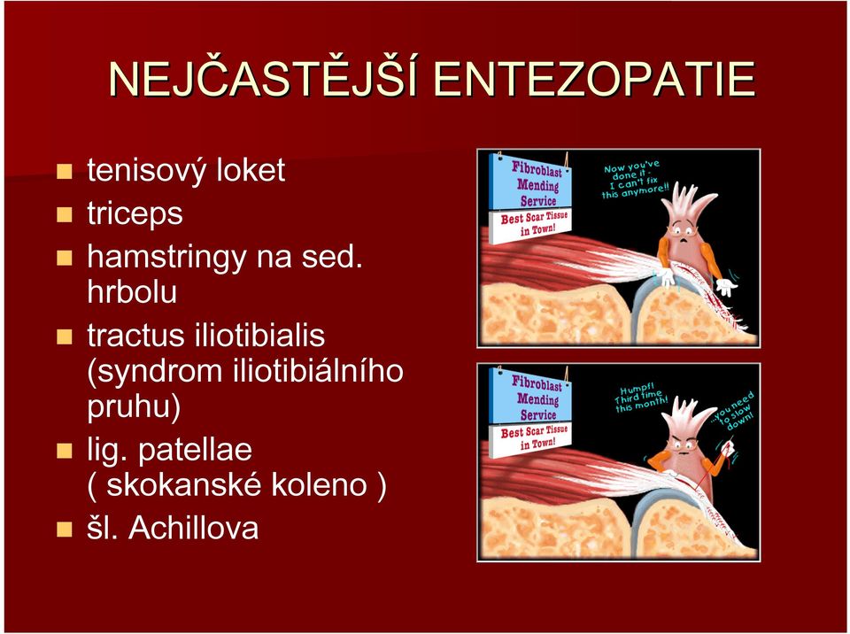 hrbolu tractus iliotibialis (syndrom