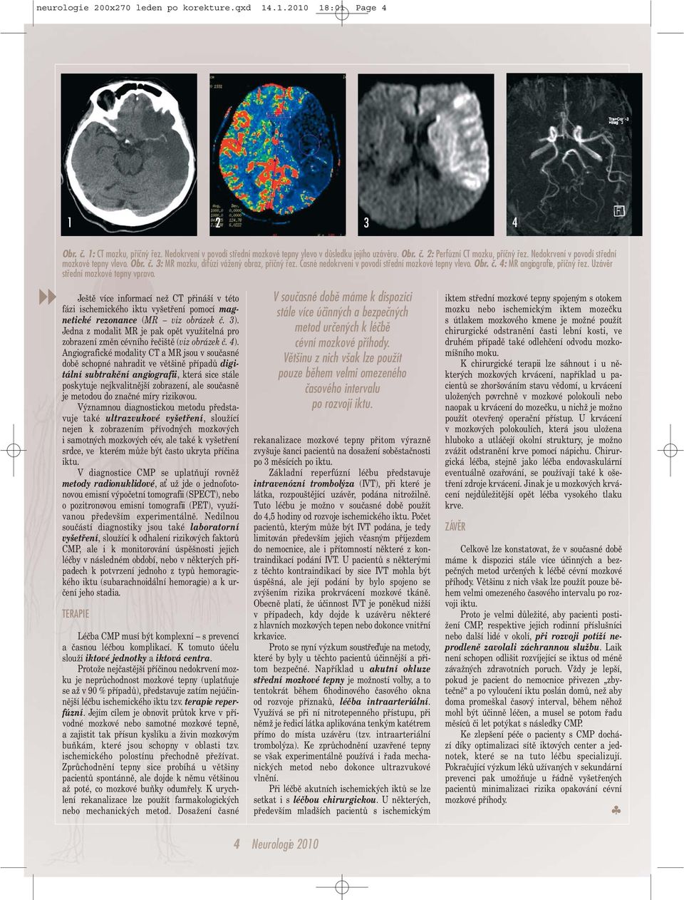 Uzávěr střední mozkové tepny vpravo. Ještě více informací než CT přináší v této fázi ischemického iktu vyšetření pomocí magnetické rezonance (MR viz obrázek č. 3).