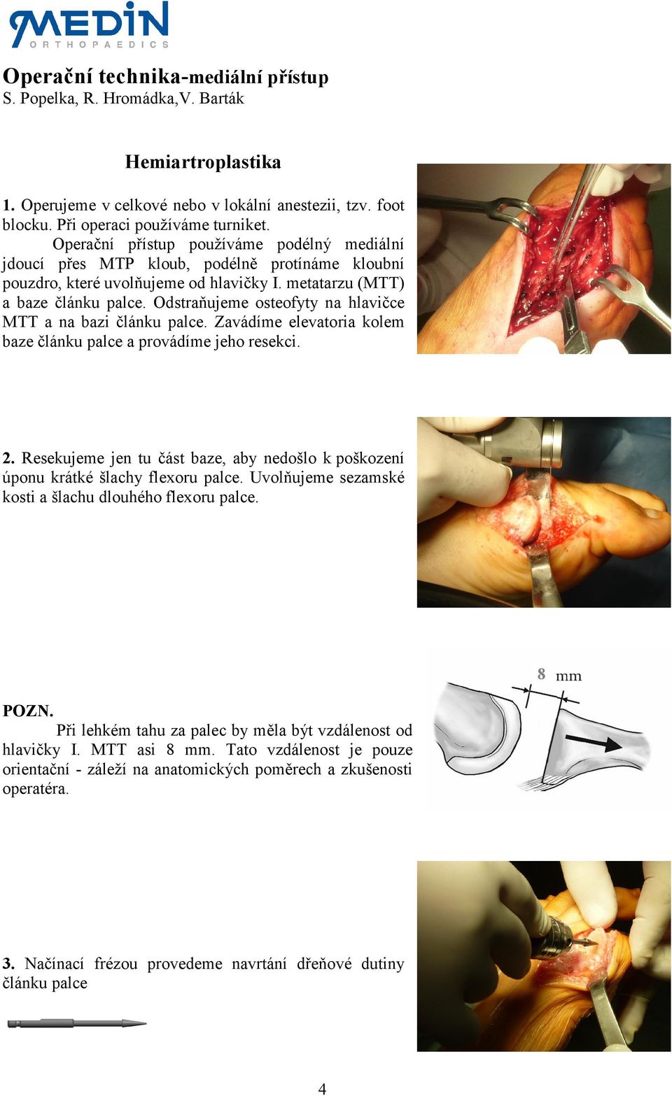 Odstraňujeme osteofyty na hlavičce MTT a na bazi článku palce. Zavádíme elevatoria kolem baze článku palce a provádíme jeho resekci. 2.