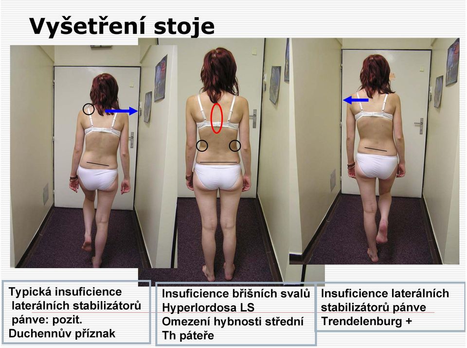 Duchennův příznak Insuficience břišních svalů Hyperlordosa