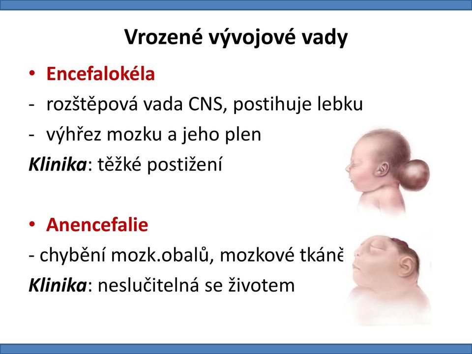 plen Klinika: těžké postižení Anencefalie - chybění