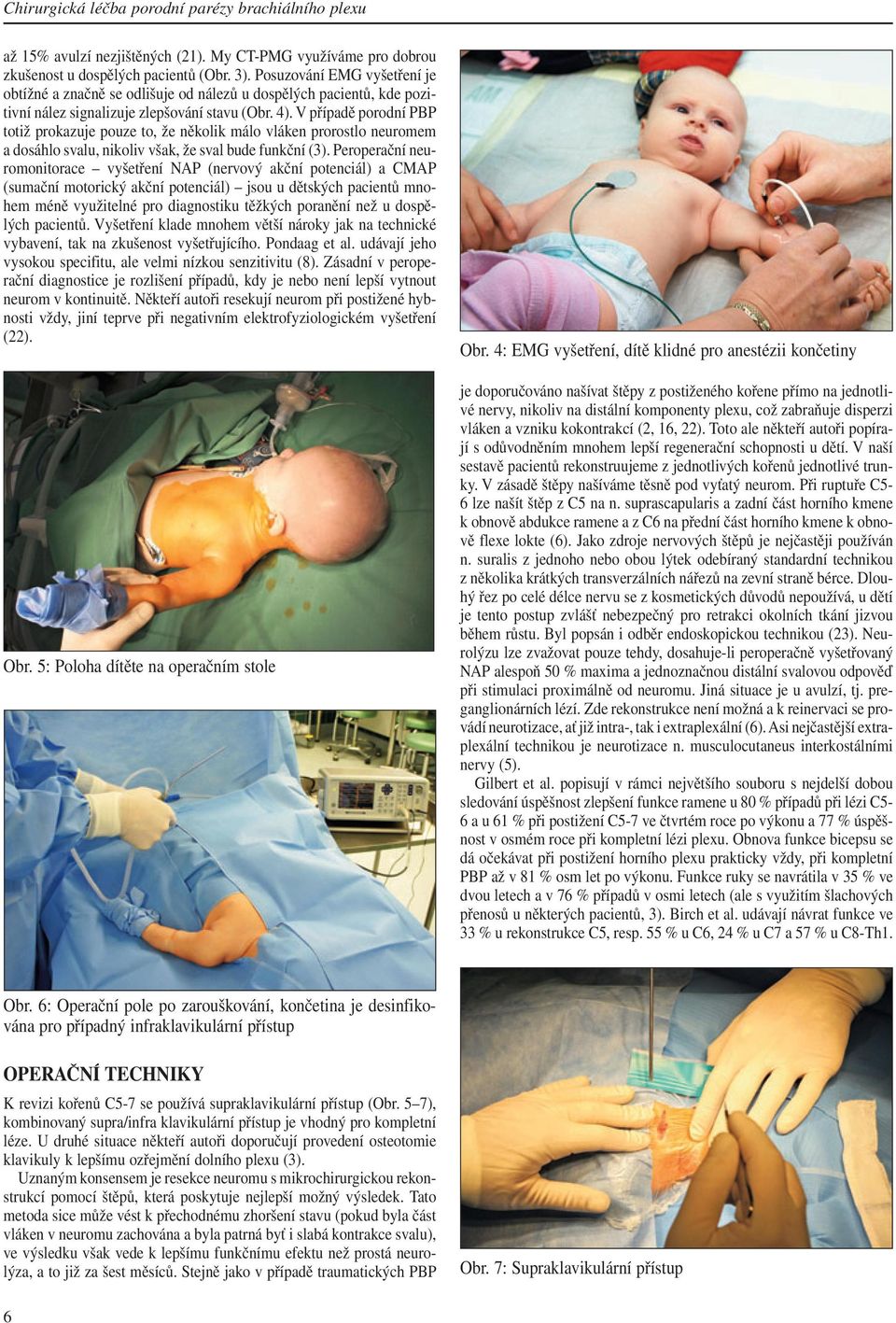 V případě porodní PBP totiž prokazuje pouze to, že několik málo vláken prorostlo neuromem a dosáhlo svalu, nikoliv však, že sval bude funkční (3).