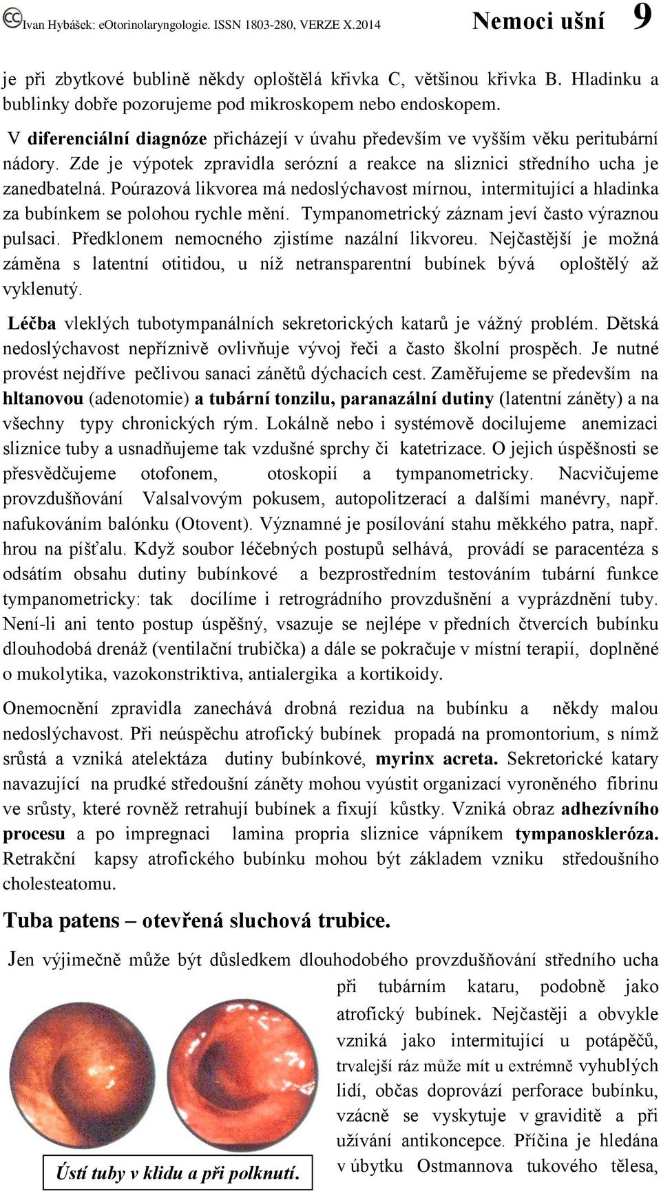 Poúrazová likvorea má nedoslýchavost mírnou, intermitující a hladinka za bubínkem se polohou rychle mění. Tympanometrický záznam jeví často výraznou pulsaci.