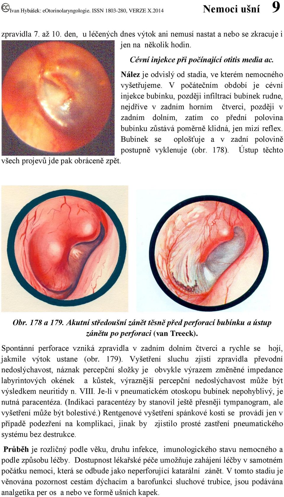 V počátečním období je cévní injekce bubínku, později infiltrací bubínek rudne, nejdříve v zadním horním čtverci, později v zadním dolním, zatím co přední polovina bubínku zůstává poměrně klidná, jen