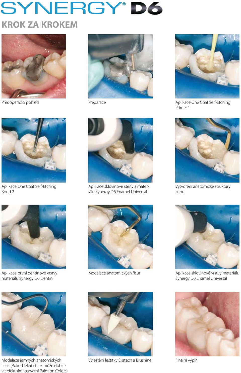 materiálu Synergy D6 Dentin Modelace anatomických fisur Aplikace sklovinové vrstvy materiálu Synergy D6 Enamel Universal Modelace