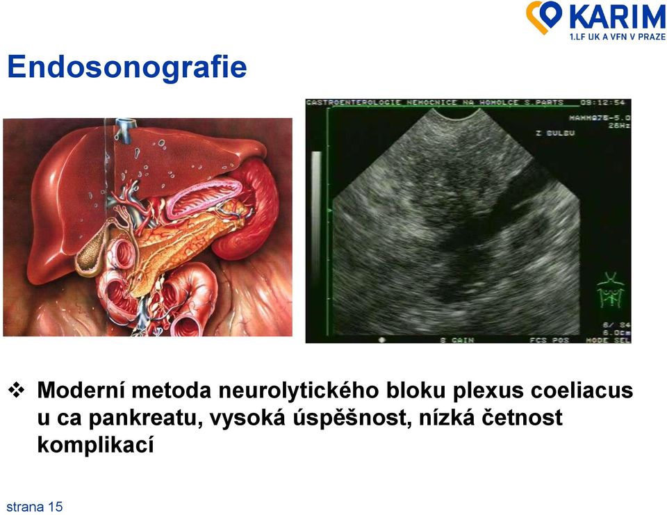 coeliacus u ca pankreatu, vysoká