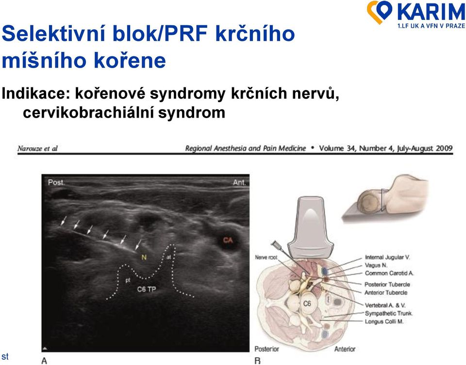 kořenové syndromy krčních