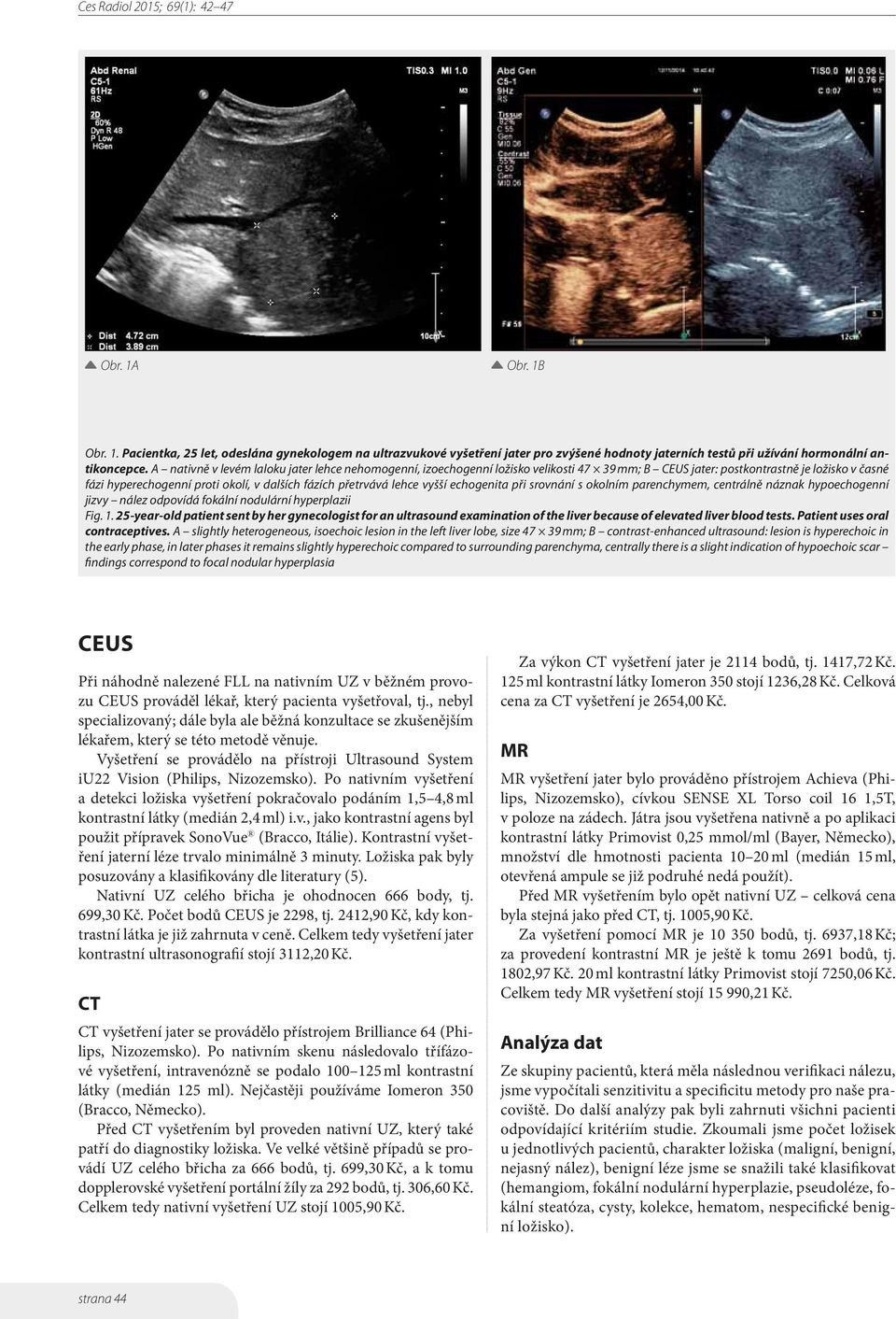 vyšší echogenita při srovnání s okolním parenchymem, centrálně náznak hypoechogenní jizvy nález odpovídá fokální nodulární hyperplazii Fig. 1.