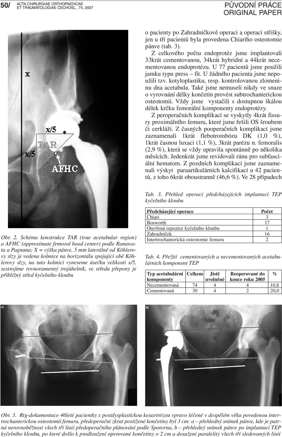 U žádného pacienta jsme nepoužili tzv. kotyloplastiku, resp. kontrolovanou zlomeninu dna acetabula. Také jsme nemuseli nikdy ve snaze o vyrovnání délky končetin provést subtrochanterickou osteotomii.