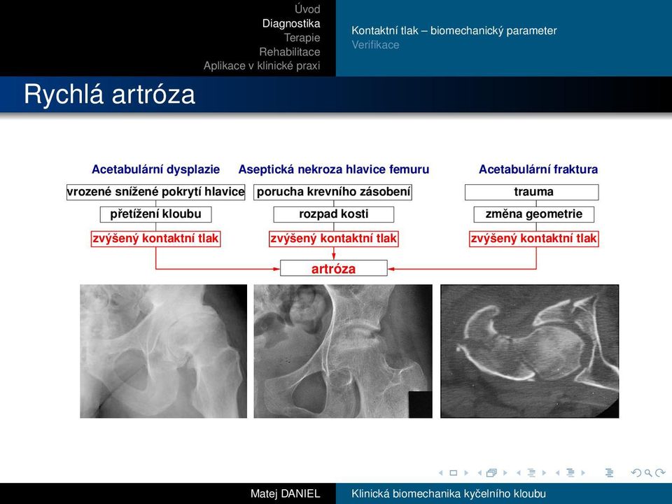 krevního zásobení přetížení kloubu rozpad kosti Acetabulární fraktura trauma změna