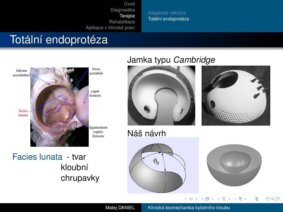 facies lunata ligamentum capitis femoris Náš návrh Facies lunata