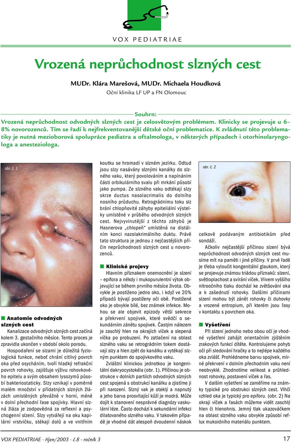 K zvládnutí této problematiky je nutná mezioborová spolupráce pediatra a oftalmologa, v některých případech i otorhinolaryngologa a anesteziologa. obr. č. 1 koutku se hromadí v slzném jezírku.