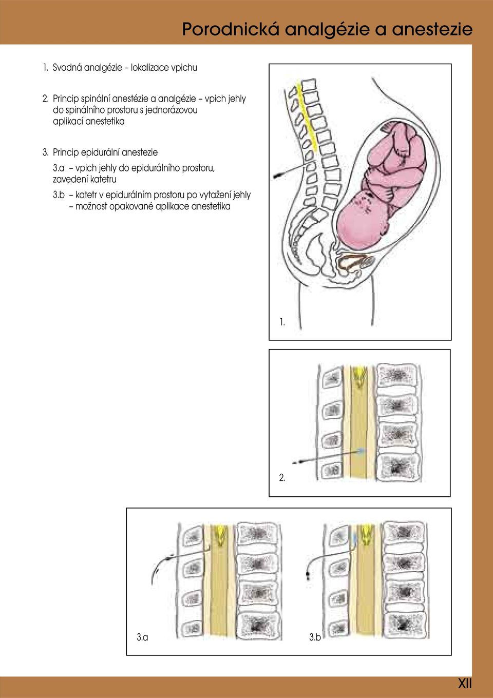 aplikací anestetika 3. Princip epidurální anestezie 3.