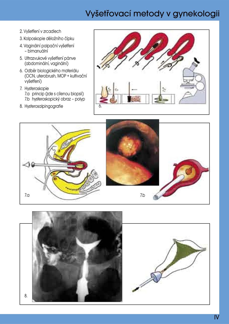 Odběr biologického materiálu (OCN, uterobrush, MOP + kultivační vyšetření) 7. Hysteroskopie 7.