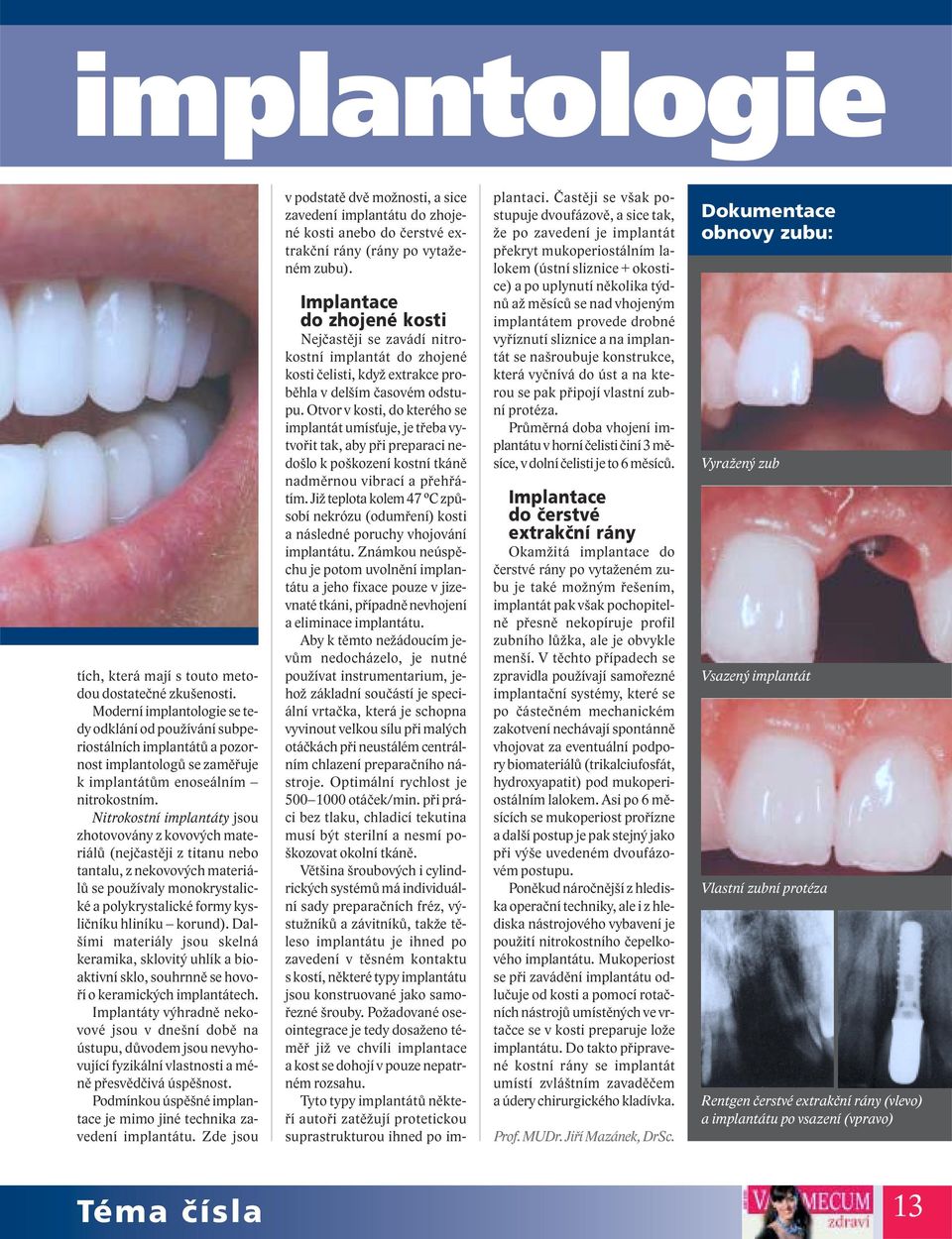 Nitrokostní implantáty jsou zhotovovány z kovových materiálů (nejčastěji z titanu nebo tantalu, z nekovových materiálů se používaly monokrystalické a polykrystalické formy kysličníku hliníku korund).