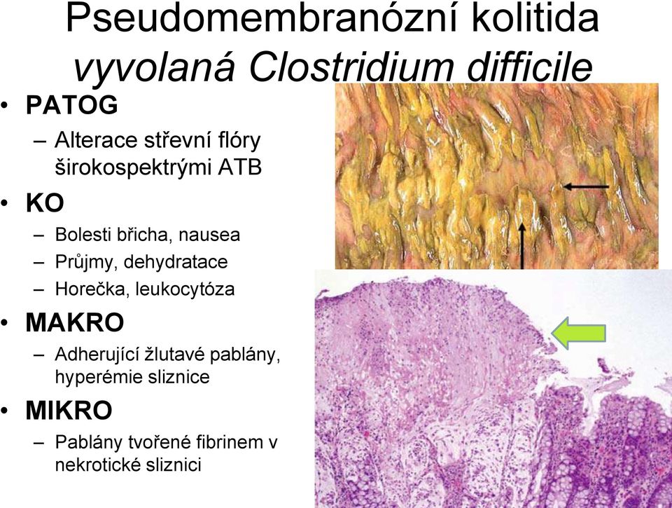 Průjmy, dehydratace Horečka, leukocytóza MAKRO Adherující žlutavé