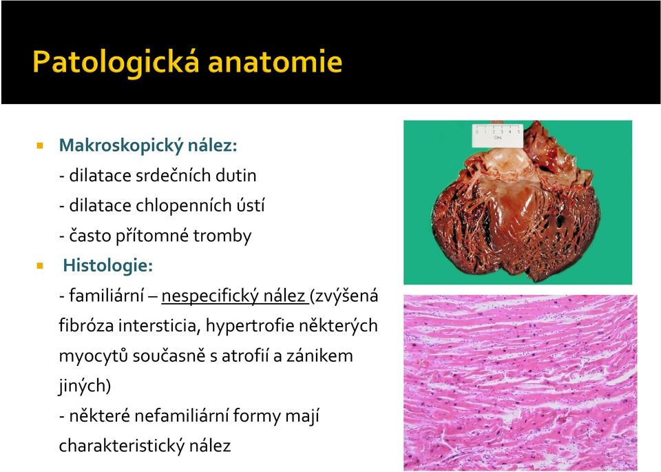 (zvýšená fibróza intersticia, hypertrofie některých myocytů současně s