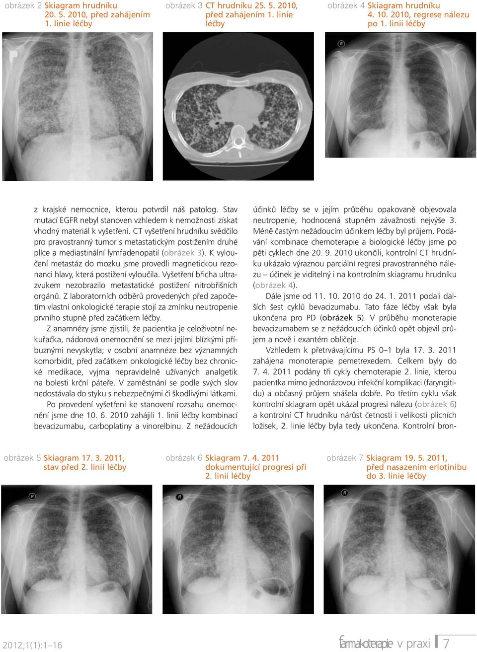CT vyšetření hrudníku svědčilo pro pravostranný tumor s metastatickým postižením druhé plíce a mediastinální lymfadenopatií (obrázek 3).