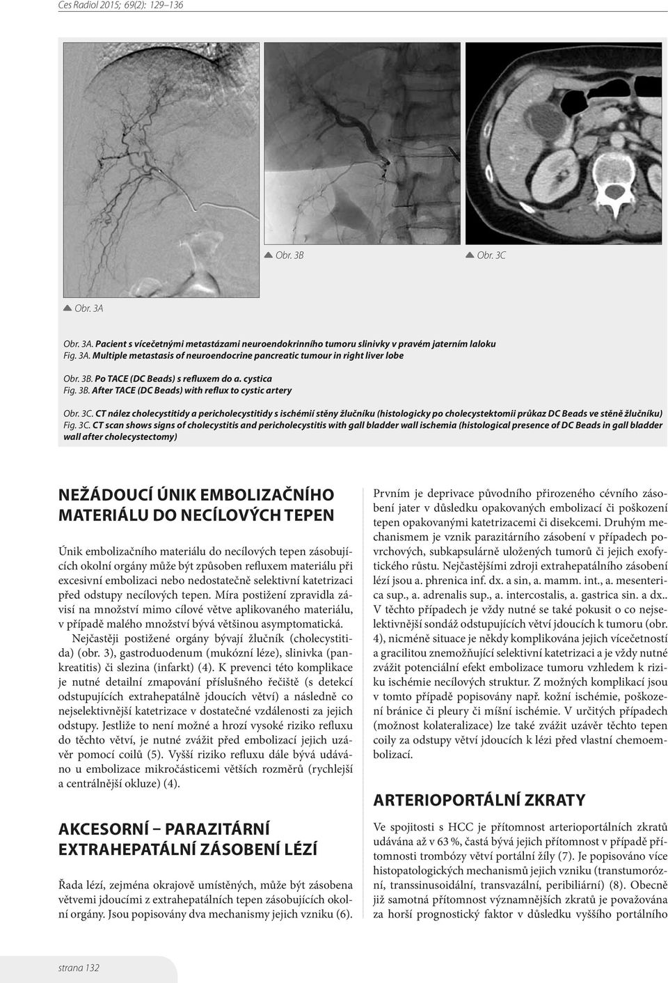 CT nález cholecystitidy a pericholecystitidy s ischémií stěny žlučníku (histologicky po cholecystektomii průkaz DC Beads ve stěně žlučníku) Fig. 3C.