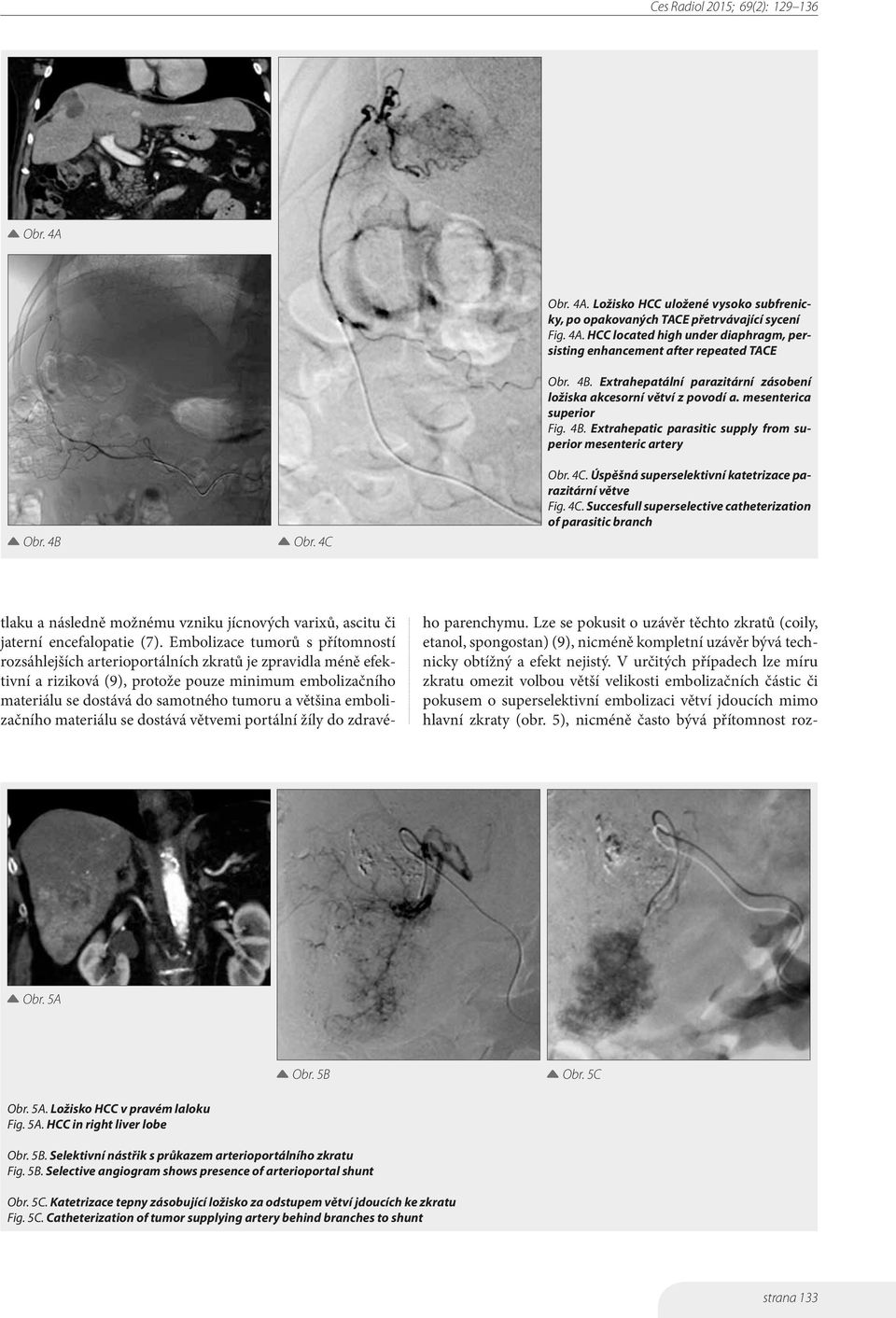 Obr. 4C. Úspěšná superselektivní katetrizace parazitární větve Fig. 4C. Succesfull superselective catheterization of parasitic branch tlaku a následně možnému vzniku jícnových varixů, ascitu či jaterní encefalopatie (7).