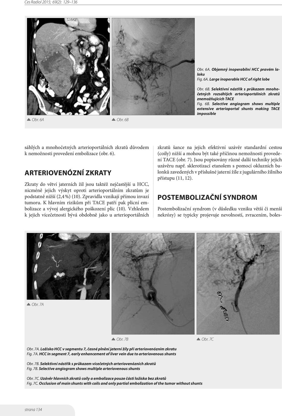 6). ARTERIOVENÓZNÍ ZKRATY Zkraty do větví jaterních žil jsou taktéž nejčastější u HCC, nicméně jejich výskyt oproti arterioportálním zkratům je podstatně nižší (2,4 %) (10).