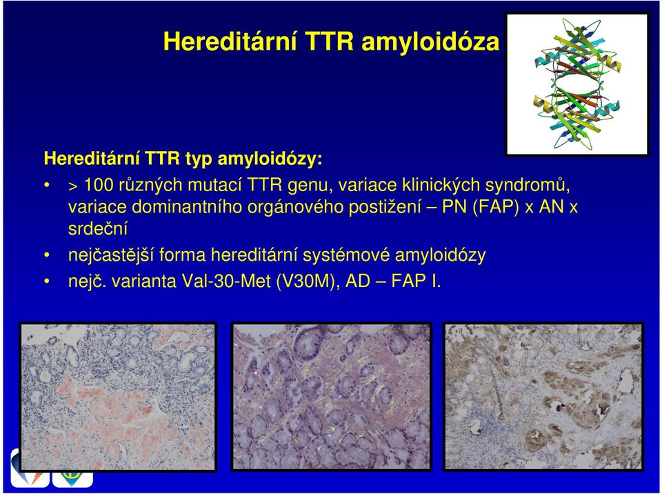 dominantního orgánového postižení PN (FAP) x AN x srdeční nejčastější