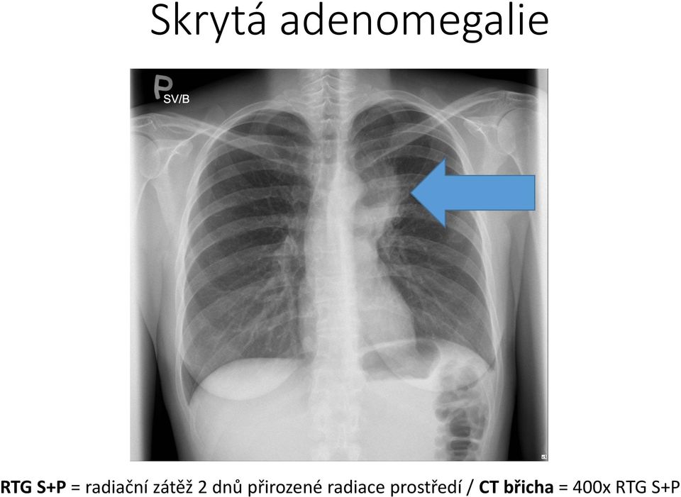 přirozené radiace