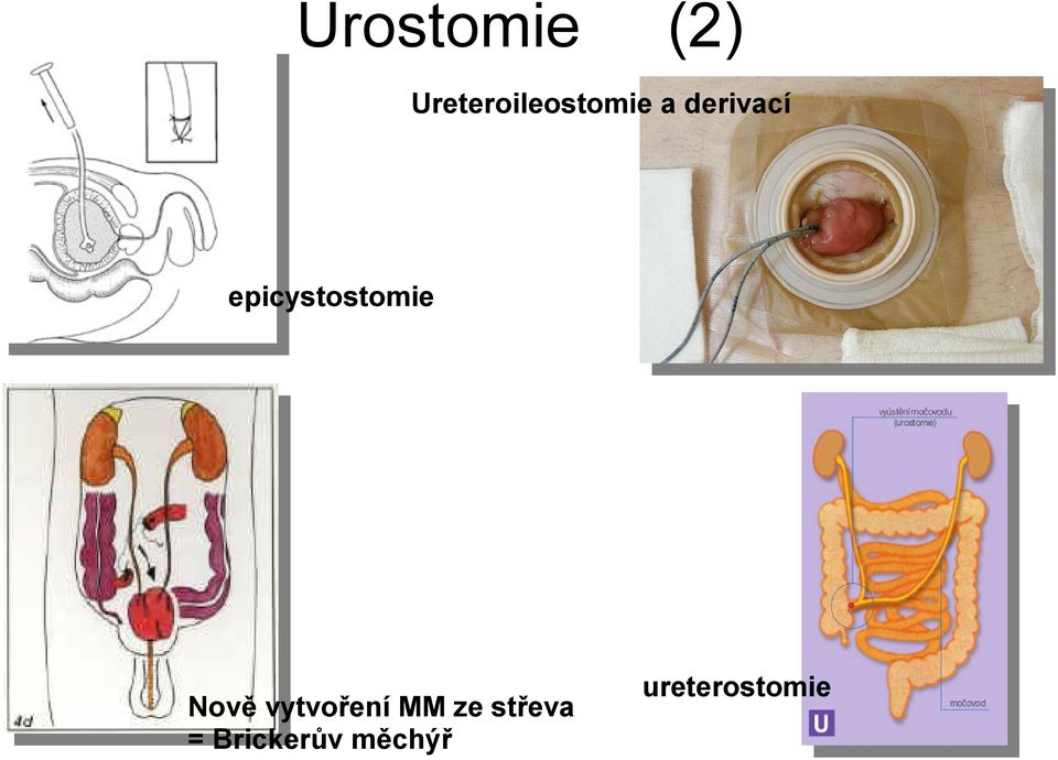 epicystostomie Nově vytvoření