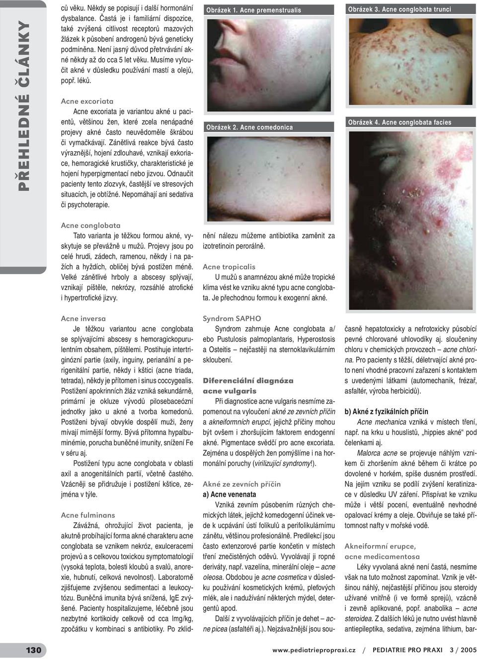 Acne excoriata Acne excoriata je variantou akné u pacientů, většinou žen, které zcela nenápadné projevy akné často neuvědoměle škrábou či vymačkávají.